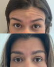 Antes e depois — Toxina Botulínica
