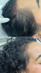 Antes e depois — Tratamento Capilar