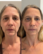 Antes e depois — Protocolo para Flacidez