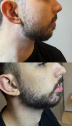 Antes e depois — Harmonização Facial
